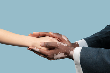 Image showing Close up of male hands with vitiligo pigments isolated on blue studio background