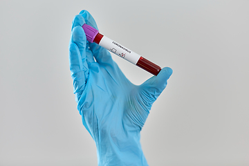 Image showing hand holding beaker with coronavirus blood test