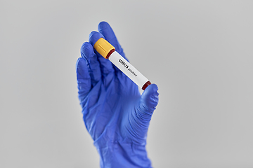 Image showing hand holding beaker with positive virus blood test