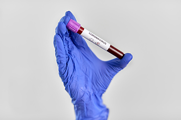 Image showing hand holding beaker with coronavirus blood test