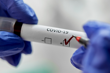 Image showing hand holding beaker with coronavirus blood test