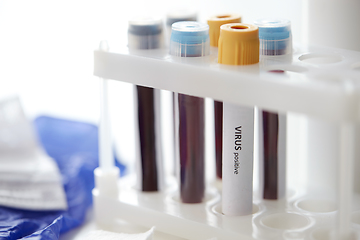 Image showing beakers with coronavirus blood test in holder