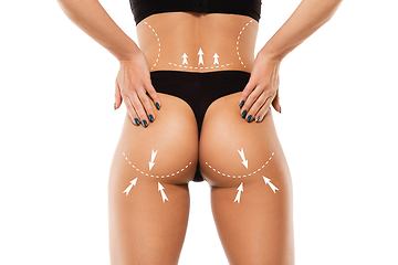 Image showing Cellulite removal plan. The black markings on young woman body preparing for plastic surgery. Concept of body correction