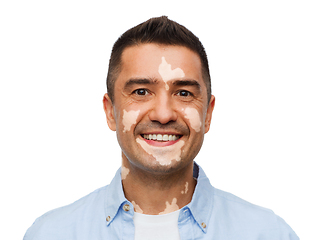 Image showing happy smiling man with vitiligo