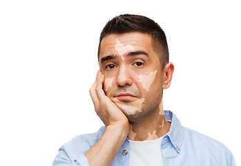 Image showing unhappy sad man with vitiligo