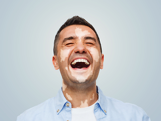 Image showing happy laughing man with vitiligo