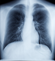 Image showing X-Ray Image Of Human Chest