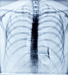 Image showing X-Ray Image Of Human Chest