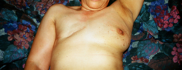 Image showing Breast cancer surgery.