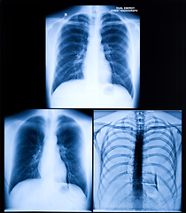 Image showing X-Ray Image Of Human Chest