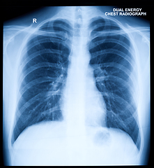 Image showing X-Ray Image Of Human Chest