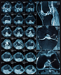 Image showing Magnetic resonance tomography (MRT) images of knee