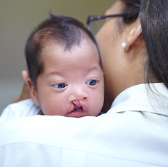 Image showing Medical, cleft lip and a pediatrician with a baby in the hospital for insurance, care or treatment. Healthcare, children and a doctor woman holding a newborn with a disability in a health clinic