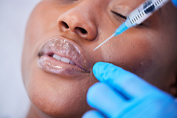 Image showing Plastic surgery, needle and black woman with lip filler closeup on a hospital bed with dermatology. Surgeon, facial change and for skincare, cosmetics and wellness in a clinic with doctor hand