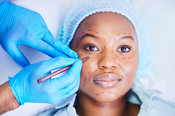 Image showing Plastic surgery, pen and black woman portrait on a hospital bed with dermatology with face mark. Surgeon, facial change and medical filler for skincare, cosmetics and wellness in clinic with doctor