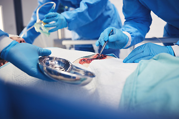 Image showing Medical tools, group hands and surgery operation, hospital service or doctors healing wound, injury or patient anatomy. Health risk problem, ICU and closeup surgeon teamwork in operating room theatre