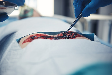 Image showing Wound surgery, hand and patient operation, hospital emergency or doctor healing client anatomy, body or injury cut. Closeup medical tools, blood or medical surgeon saving life of person with tweezers