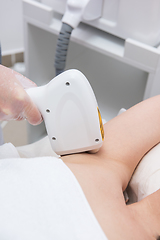 Image showing Laser epilation of armpits