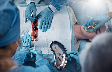 Image showing Top view, teamwork of doctors and surgery of patient in hospital. Healthcare, collaboration and group of people or medical professionals performing a surgical operation on man in operation theater.