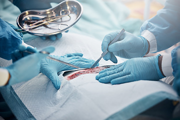 Image showing Doctors, nurses or surgery hands on cut patient in hospital emergency room for stomach ulcer, heart attack or burst appendix. Zoom, healthcare workers or surgical operation and steel metal equipment