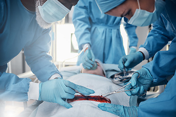 Image showing Doctors, nurses or surgery hands on cut patient in hospital emergency room for stomach ulcer or burst appendix. Zoom, healthcare workers or surgical operation and steel metal equipment