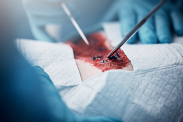 Image showing Doctors, nurses or surgery hands on cut patient in hospital emergency room for stomach ulcer, heart attack or burst appendix. Blood, healthcare workers or surgical operation and steel metal equipment