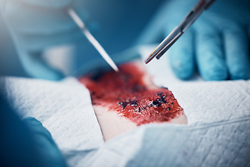 Image showing Doctors, nurses or surgery hands on cut patient in hospital emergency room for stomach ulcer, heart attack or burst appendix. Blood, healthcare workers or surgical operation and steel metal equipment