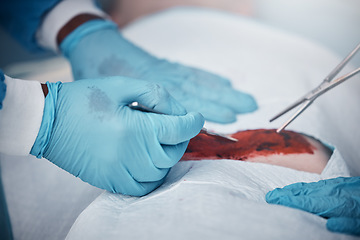 Image showing Hands, blood and operation with a team of doctors at work during surgery with equipment or a tool in a hospital. Doctor, nurse and collaboration with a medicine professional group saving a life