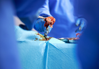 Image showing Hands, surgery and cancer with doctors in a hospital to remove a tumor closeup during a medical procedure. Healthcare, medicine and operation with a surgeon team in a clinic for emergency transplant