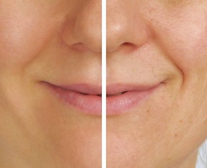 Image showing Correction of wrinkles on half of face