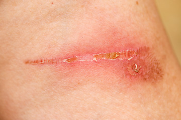 Image showing Burn Scar Detail