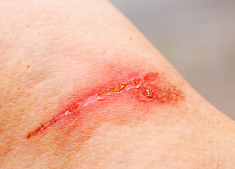 Image showing Burn Scar