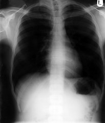 Image showing Chest x-ray