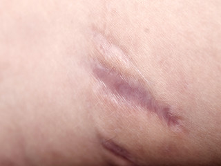 Image showing scar