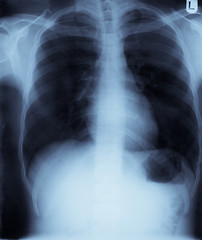 Image showing Chest x-ray