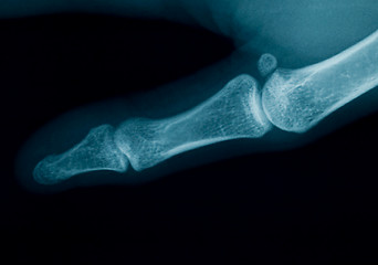 Image showing Finger  x-ray