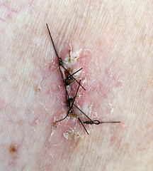 Image showing surgical sutures