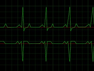 Image showing Normal Heart Rhythm