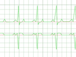 Image showing Normal Heart Rhythm