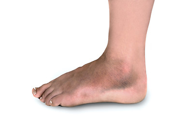 Image showing Woman With Broken Foot