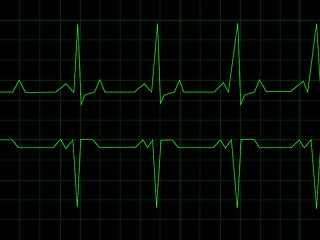 Image showing Normal Heart Rhythm