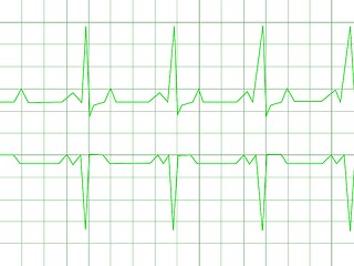 Image showing Normal Heart Rhythm