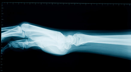 Image showing Hand wrist x-ray