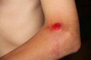 Image showing Scraped Up Bleeding Elbow