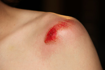 Image showing Bleeding Shoulder Injury