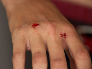 Image showing Injured Bleeding Hand