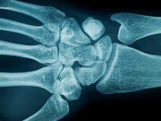 Image showing Hand wrist x-ray