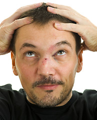 Image showing broken nose and black eye