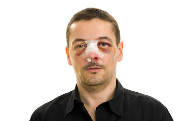 Image showing broken nose and black eyes post operation