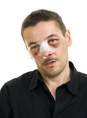 Image showing broken nose and black eyes post operation